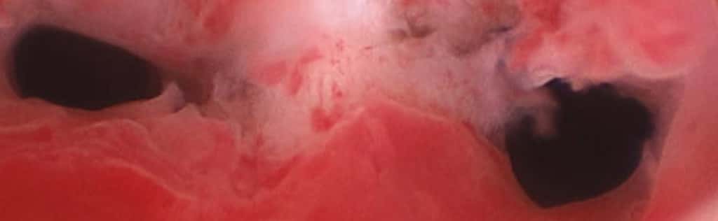 uterine