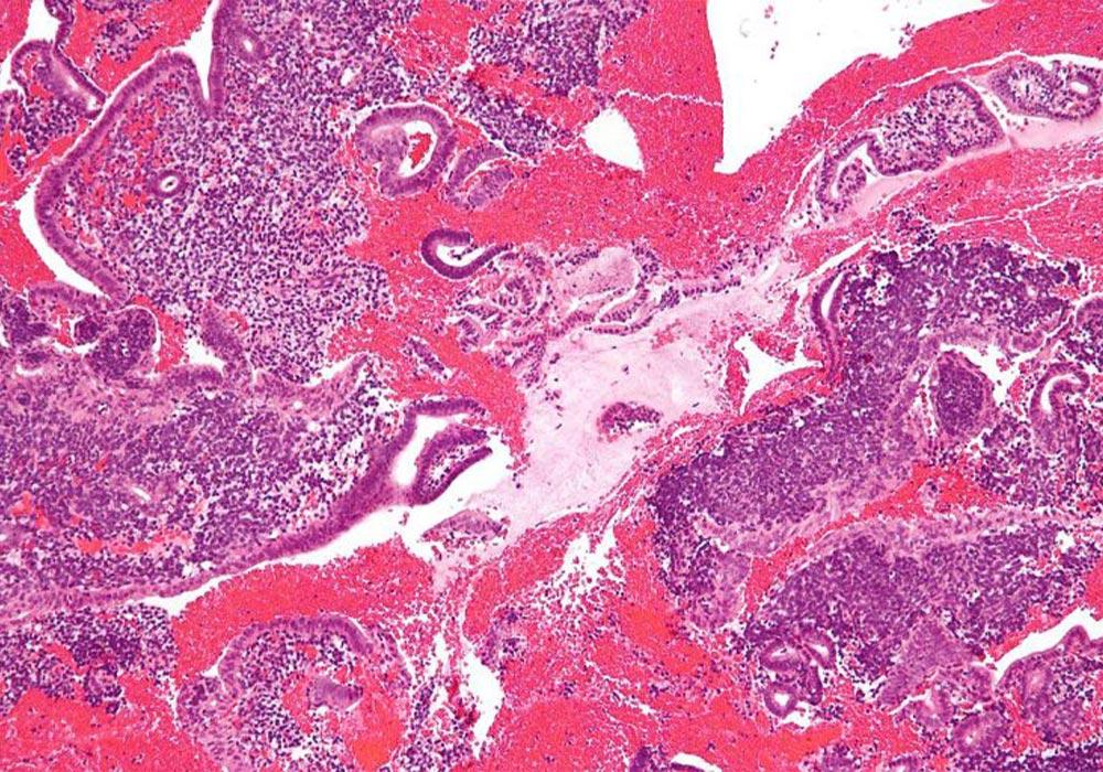 Iperplasia-endometriale-e-infertilita