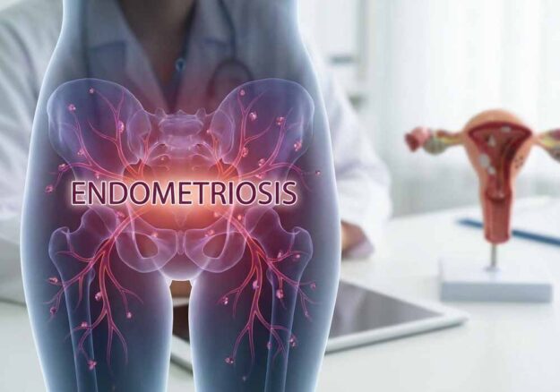 endometriosi
